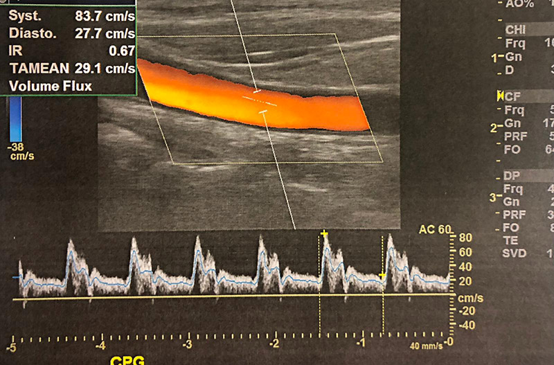 Par Quoi Remplacer Le Gel Pour Doppler